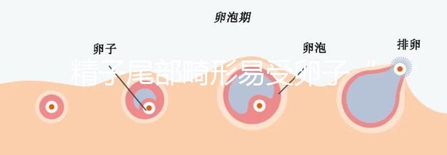 精子尾部畸形易受卵子“嫌棄”,無尾、短卷尾需重視