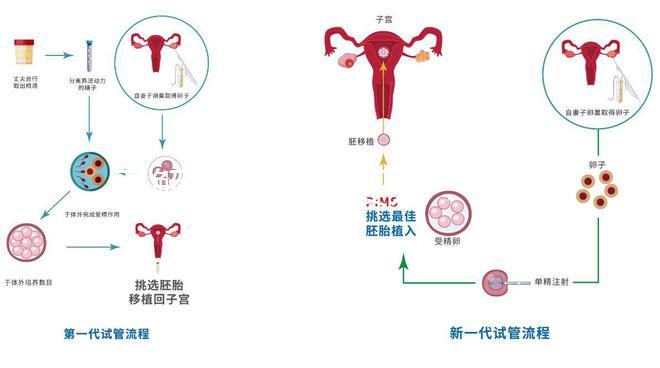 了解二代試管嬰兒：技術原理與優勢解析