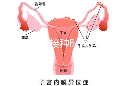 麻疹疫苗接種時間指南，初種年齡最好不要晚于這個月齡