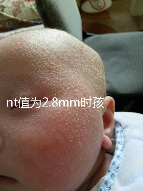 nt值為2.8mm時(shí)孩子也能要,正常與否還要進(jìn)一步檢查